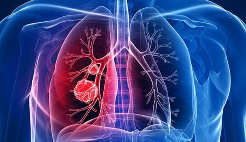 دوره آموزشی بیماریهای پلور دستیاران فوق تخصص ریه کشور
