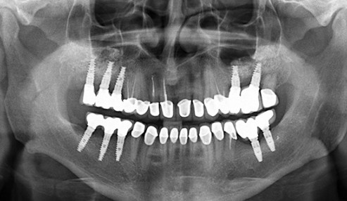 وبینار علمی  تکنیکهای تصویربرداری در ایمپلنت دندانی