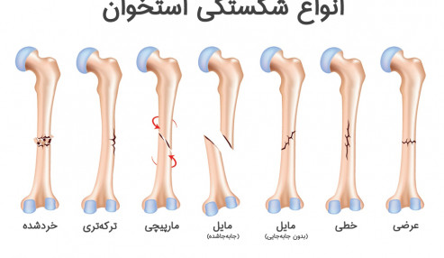 وبینار علمی  شکستگی استخوان نازال