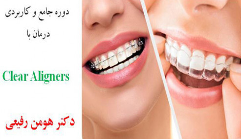 دوره کارگاهی و کاربردی Clear Aligners