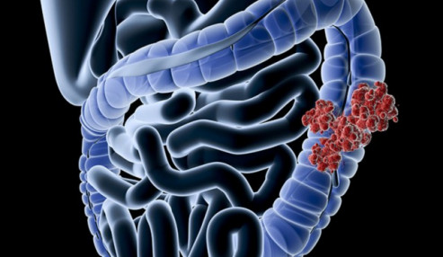 وبینار علمی  تازه های درمان سرطان کولون متاستاتیک