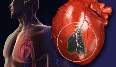وبینار علمی  مدیریت سکته های قلبی